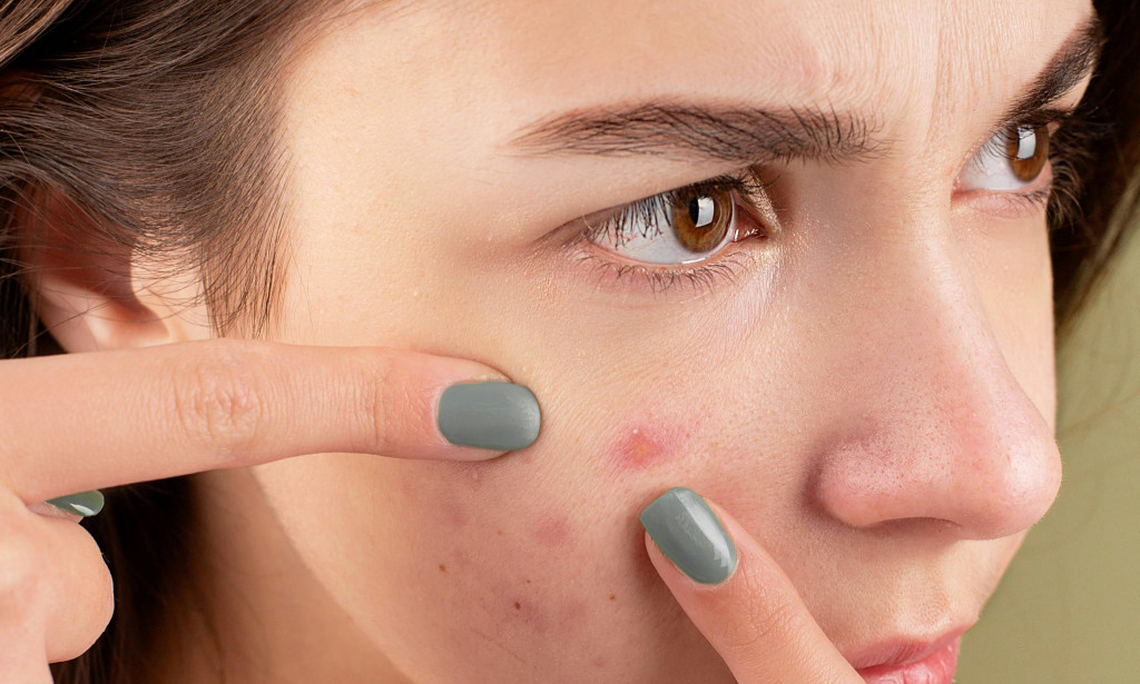 Can I Use Acne Control Gel Every Day?